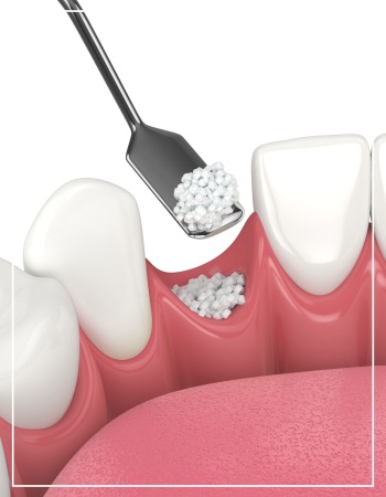 Dental Bone Graft Near Me in Beverly Hills, CA