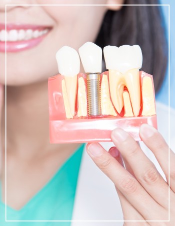 Dental Implants Near Me in Beverly Hills, CA