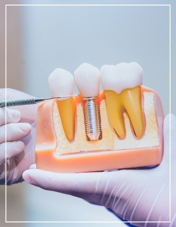 Full Arch Dental Implant Near Me in Beverly Hills, CA