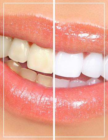 Teeth Whitening Near Me in Beverly Hills, CA