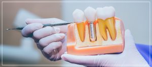 Full Arch Dental Implant Dentist in Beverly Hills, CA